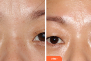 廣州美涵醫(yī)療整形美容醫(yī)院李晶整形價格表附皮膚管理案例展示