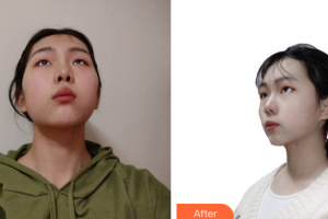 廣州美恩整形美容醫(yī)院楊紅云整形價格表附光子嫩膚案例展示