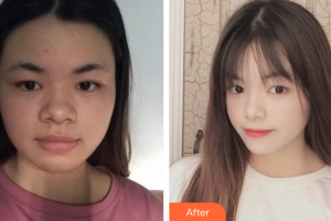 廣州美恩整形美容醫(yī)院羅凌整形價格表附面部埋線提升案例展示