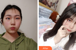 廣州利美康粵美醫(yī)療美容門診部周碧燕整形價格表附超激光美膚案例展示