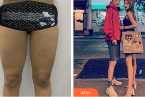 廣州新時代整形美容醫(yī)院張光疇整形價格表附大腿吸脂案例展示