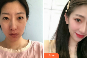 廣州曙光醫(yī)學美容醫(yī)院杜錫萍整形價格表附光子嫩膚案例展示