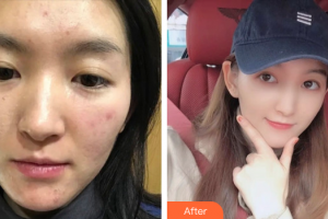 廣州新時代整形美容醫(yī)院紀麗萍整形價格表附微針祛痘 案例展示