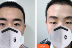 廣州曙光醫(yī)學美容醫(yī)院蔣晟整形價格表附假體墊眉弓案例展示