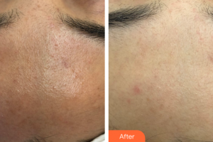 廣州曙光醫(yī)學美容醫(yī)院杜小燕整形價格表附海菲秀醫(yī)學深層清潔案例展示