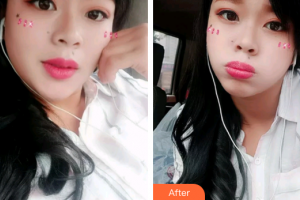 廣州曙光醫(yī)學美容醫(yī)院熊飛整形價格表附冷光美白案例展示