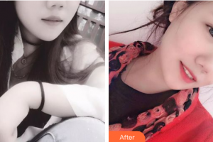 廣州曙光醫(yī)學美容醫(yī)院張昌輝整形價格表附瓷貼面案例展示