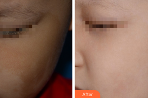 廣州曙光醫(yī)學美容醫(yī)院吳艷整形價格表附祛斑祛痣案例展示