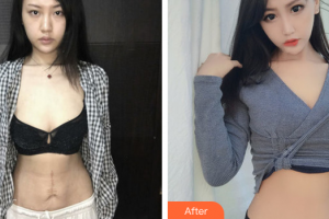 廣州曙光醫(yī)學美容醫(yī)院彭雙英整形價格表附激光祛疤案例展示