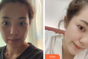 廣州曙光醫(yī)學美容醫(yī)院馬小兵整形價格表附光子嫩膚案例展示