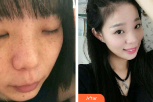 廣州曙光醫(yī)學美容醫(yī)院梁虹整形價格表附雙機祛斑案例展示