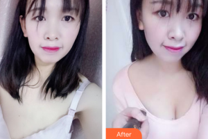 廣州曙光醫(yī)學美容醫(yī)院郭澍整形價格表附自體脂肪隆胸案例展示
