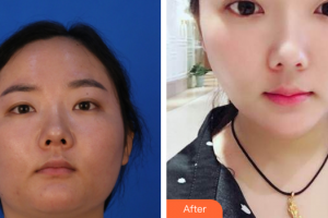 廣州曙光醫(yī)學美容醫(yī)院楊慧蘭整形價格表附皮膚管理案例展示