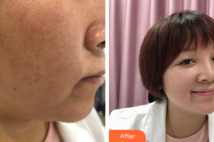 廣州曙光醫(yī)學美容醫(yī)院李利整形價格表附微針美塑案例展示