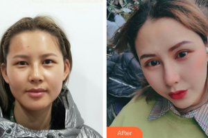 廣州韓妃醫(yī)學美容醫(yī)院李光琴整形價格表附格萊美眼部手術案例展示