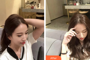 廣州華美醫(yī)療美容醫(yī)院馬奔芳整形價格表附皮膚管理案例展示