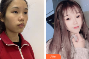 廣州曙光醫(yī)學美容醫(yī)院黃詠梅整形價格表附光子嫩膚案例展示