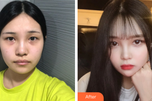 廣州華美醫(yī)療美容醫(yī)院李有真整形價格表附頜面整形案例展示