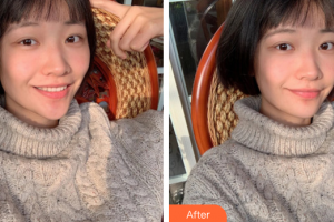 廣州華美醫(yī)療美容醫(yī)院郭曼麗整形價格表附水氧活膚案例展示