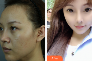 廣州時(shí)光整形美容醫(yī)院宋彥整形價(jià)格表附顴骨+頰脂墊+中面部提升術(shù)案例展示