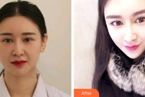 廣州時(shí)光整形美容醫(yī)院金相虎整形價(jià)格表附納米V-FACE分層吸脂術(shù)案例展示