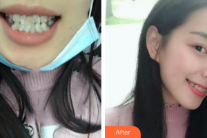 廣州韓妃醫(yī)學(xué)美容醫(yī)院徐建整形價(jià)格表附半隱形牙齒矯正案例展示