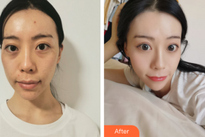 廣州華美醫(yī)療美容醫(yī)院金智妍整形價(jià)格表附面部埋線提升案例展示