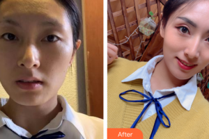 廣州市荔灣區(qū)人民醫(yī)院整形美容中心陳維整形價(jià)格表附埋線提升案例展示