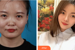 廣州市荔灣區(qū)人民醫(yī)院整形美容中心山口青木整形價(jià)格表附臉型（顴骨+下頜角）+鼻部手術(shù)案例展示