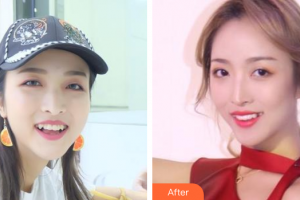 廣州華美醫(yī)療美容醫(yī)院鄭偉成整形價(jià)格表附牙齒矯正案例展示