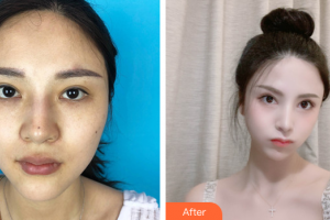 廣州韓妃醫(yī)學(xué)美容醫(yī)院金明轍整形價(jià)格表附眼瞼下至+面部吸脂+M唇案例展示