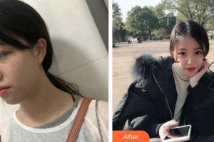 廣州海峽醫(yī)學(xué)整形美容醫(yī)院吳光興整形價(jià)格表附超激光美膚激光案例展示