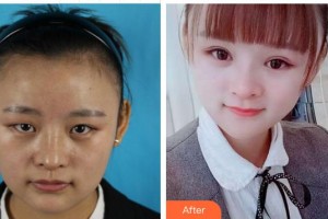 成都恩喜醫(yī)學(xué)整形美容醫(yī)院張曉琴整形價(jià)格表附眼部手術(shù)案例展示