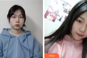 成都恩喜醫(yī)學(xué)整形美容醫(yī)院姜玄哲整形價(jià)格表附埋線提升案例展示