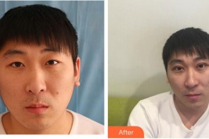 成都華康醫(yī)院美容整形外科錢凱整形價(jià)格表附切開雙眼皮案例展示