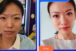 成都素美醫(yī)療美容診所楊華博整形價(jià)格表附5s重瞼術(shù)+超微創(chuàng)開內(nèi)眥案例展示