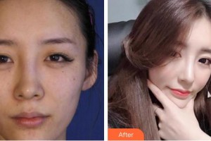 成都花田醫(yī)療美容門診部陳剛整形價(jià)格表附水光案例展示