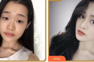 成都百齡駐顏醫(yī)學(xué)美容門診部肖凌整形價(jià)格表附鼻部綜合案例展示