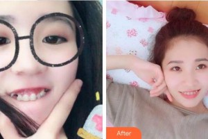 成都醫(yī)美整形美容醫(yī)院柳媛媛整形價(jià)格表附牙齒矯正案例展示