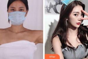 成都百齡駐顏醫(yī)學(xué)美容門診部李文祥整形價(jià)格表附手臂吸脂案例展示