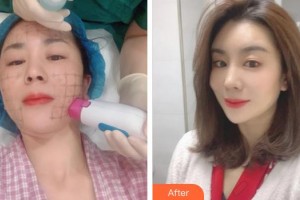 成都蜀尚蓉雅美容整形醫(yī)院蔣琳整形價(jià)格表附熱瑪吉案例展示