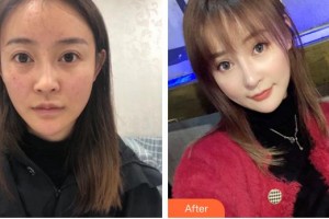 成都維度醫(yī)療美容診所周維整形價(jià)格表附鼻部手術(shù)-鼻頭大 山根低案例展示