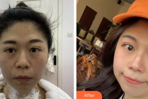 成都美極醫(yī)療美容門診部屈武整形價(jià)格表附熱瑪吉抗衰案例展示