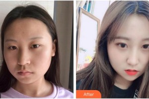 成都泊菲凱莉醫(yī)學(xué)整形美容醫(yī)院許文澍整形價格表附埋線提升案例展示