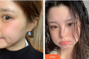 成都嬌點醫(yī)學(xué)美容醫(yī)院孫葉培整形價格表附激光美膚激光案例展示