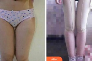 成都唯羅納醫(yī)療美容門診部李從從整形價格表附吸脂瘦大腿案例展示