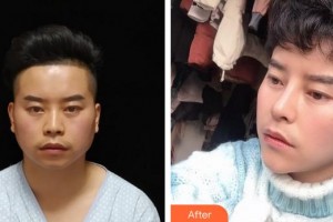 成都市錦江區(qū)第二人民醫(yī)院醫(yī)學(xué)美容科李蓉整形價格表附鼻部手術(shù)案例展示