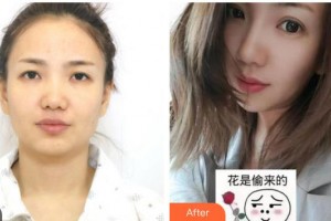 成都俏百顏美容整形醫(yī)院劉柏林整形價格表附雙眼皮案例展示