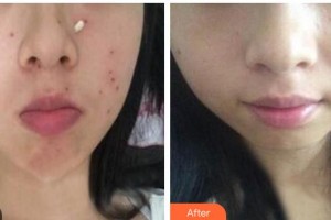 成都濟慈德美醫(yī)療美容門診部鄭光靜整形價格表附激光點痣案例展示