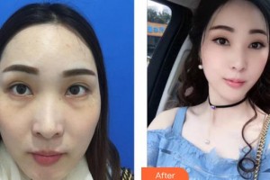 成都藝星醫(yī)療美容醫(yī)院蒲于紅整形價格表附激光去眼袋案例展示